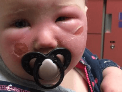 Health Canada investigating 2 complaints of babies burned by Banana Boat sunscreen