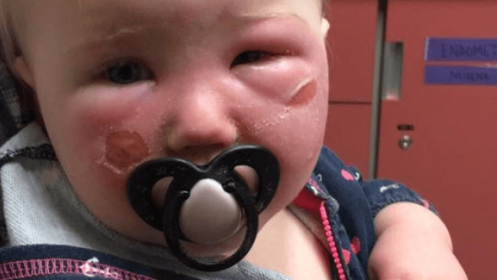 Health Canada investigating 2 complaints of babies burned by Banana Boat sunscreen