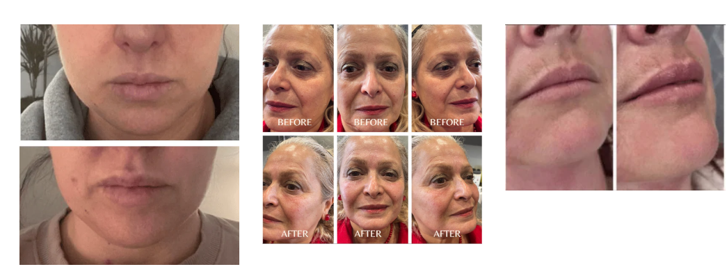 Double Chin Dilemma? Belkyra Treatment in Regina can help you to transform