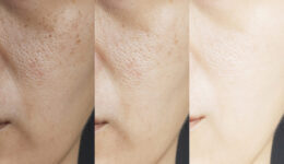 September Skin Care Awareness, Prevention, and the Rise of Skin Cancer